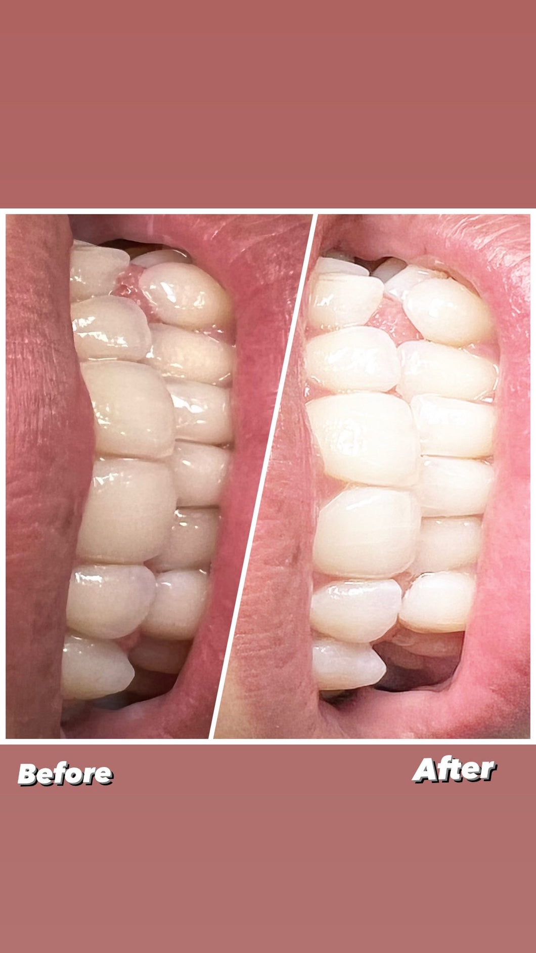 Teeth whitening LED Light Accelerated